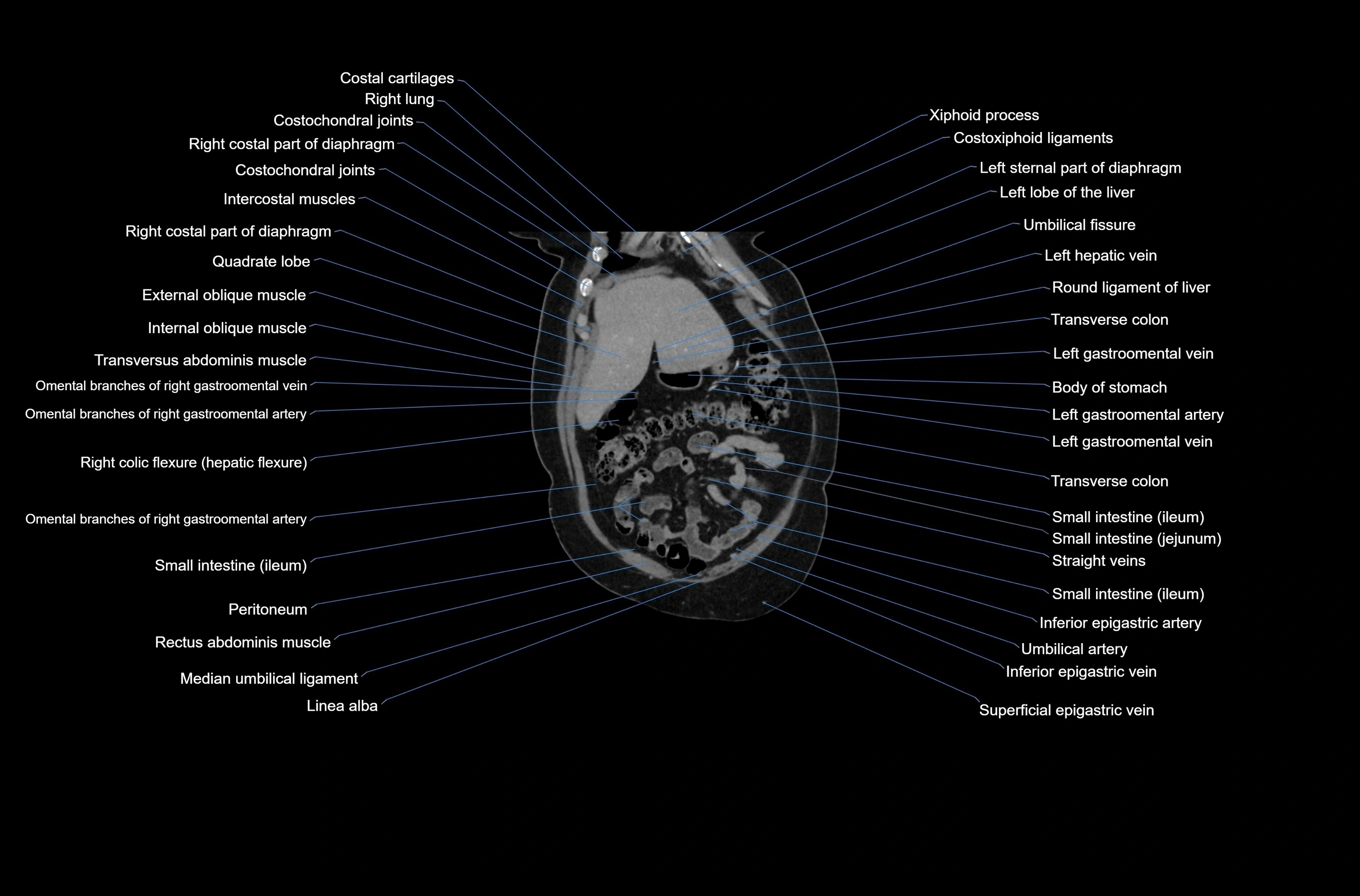 CT abdomen coronal cross sectional anatomy labelled radiology image-00016.webp